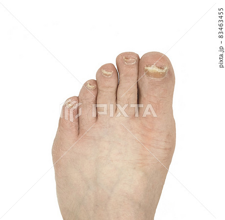 Nail fungus. The foot of a man's leg, with nails diseased with fungus. Isolated image on white background 83463455