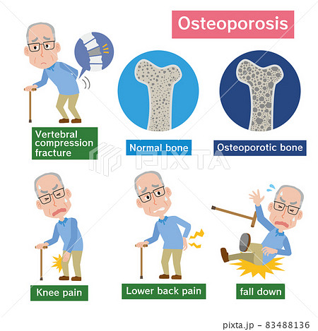 骨粗しょう症のイメージと高齢男性 83488136