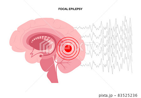 epilepsy seizure concept 83525236