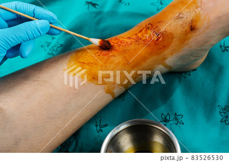 close up doctor cleaning wound on leg, Injuries from falling close up doctor cleaning wound on leg, Injuries from falling 83526530
