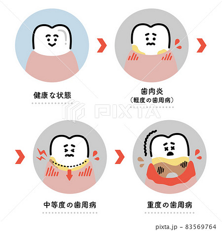 歯周病の進行 イラストセット 日本語ver のイラスト素材