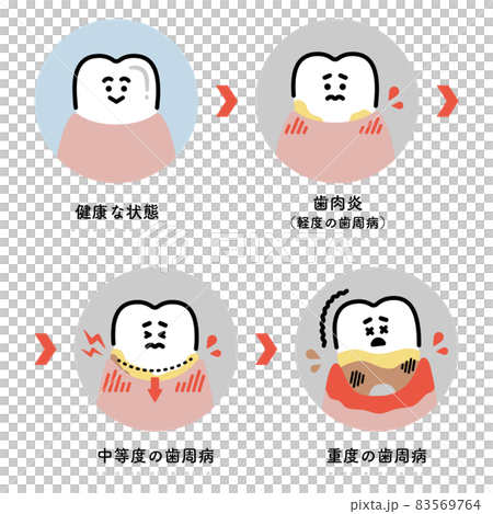 歯周病の進行　イラストセット（日本語ver.） 83569764
