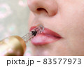 Lip augmentation treatment hyaluron pen device 83577973
