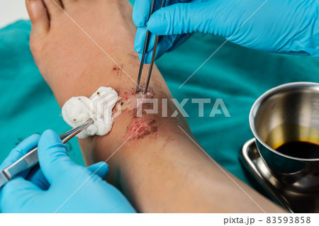close up doctor cleaning wound on leg, Injuries from falling close up doctor cleaning wound on leg, Injuries from falling 83593858