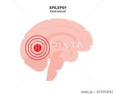 epilepsy seizure concept 83595842
