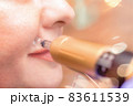 Filling wrinkles with hyaluronic acid 83611539