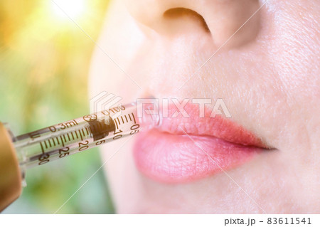 Lip augmentation treatment hyaluron pen device 83611541