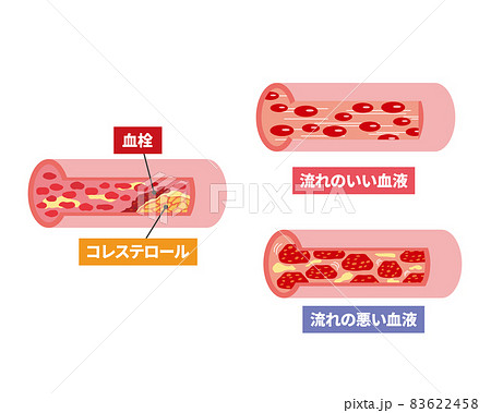 血管のトラブルの断面イメージ 83622458