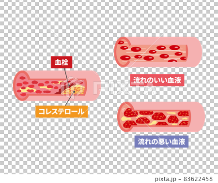 血管のトラブルの断面イメージ 83622458