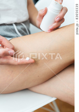 The woman has bruises on her legs, the girl spreads cream on the bruise. Domestic violence concept. Close-up. 83650339