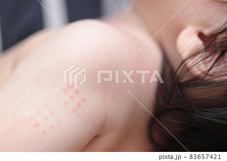 赤ちゃんの腕のBCG予防接種の注射痕 83657421