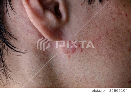 Dermatitis Skin damage Dermatitis Skin damage 83662104