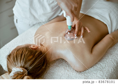 professional female specialist is doing cupping therapy on the back of beautiful caucasian lady 83678101