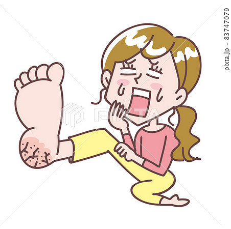 足裏がひび割れてショックな女性 83747079