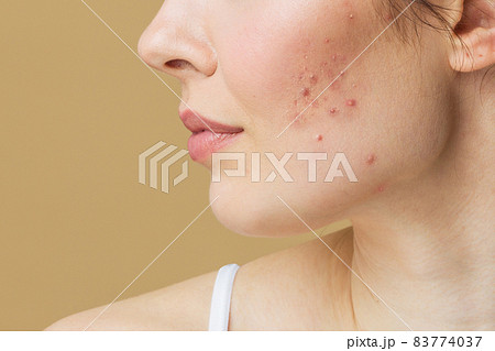 A young woman with bad skin. Skin with a lot of pimples. Acne disease, acne treatment. A young woman with bad skin. Skin with a lot of pimples. Acne disease, acne treatment. 83774037
