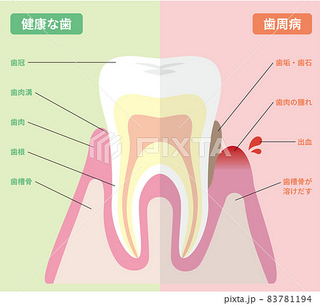 健康な歯と歯周病の歯の図解 83781194