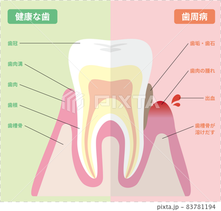健康な歯と歯周病の歯の図解 83781194
