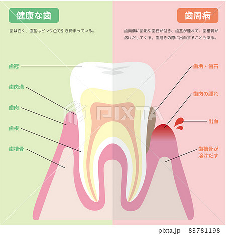 健康な歯と歯周病の歯の図解(説明付き) 健康な歯と歯周病の歯の図解(説明付き) 83781198