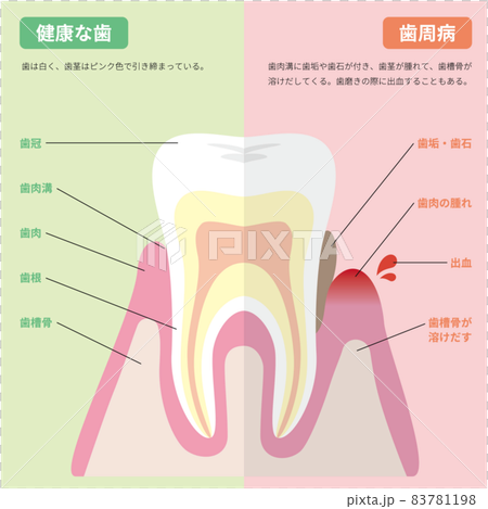 健康な歯と歯周病の歯の図解(説明付き) 健康な歯と歯周病の歯の図解(説明付き) 83781198