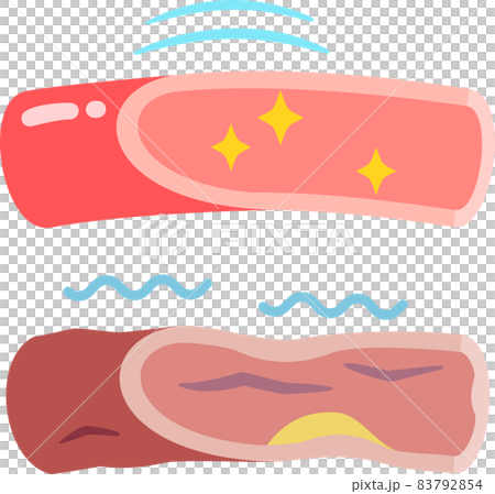 Supple blood vessels and hardened blood vessels - Stock Illustration ...