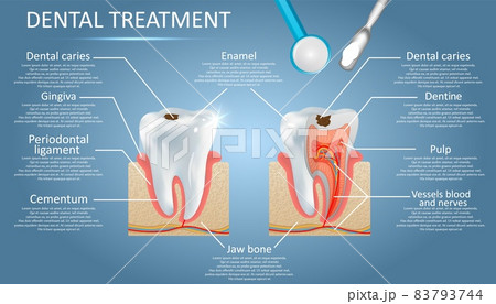 Dental treatment vector diagram education medical anatomy poster infographics Dental treatment vector diagram education medical anatomy poster infographics 83793744