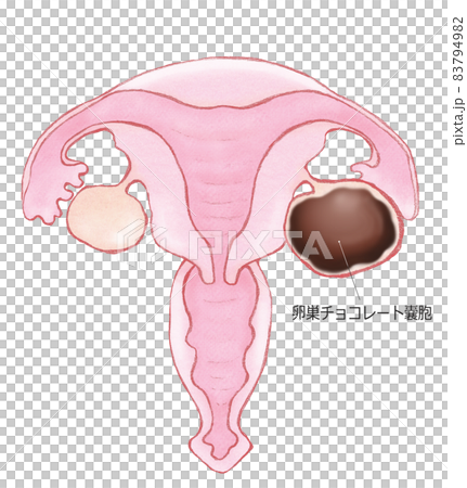 Ovarian chocolate cyst with name 83794982
