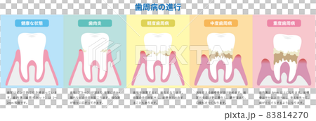 說明牙周病的進展（附說明） 83814270