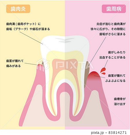 歯肉炎から歯周病への進行 説明付き のイラスト素材