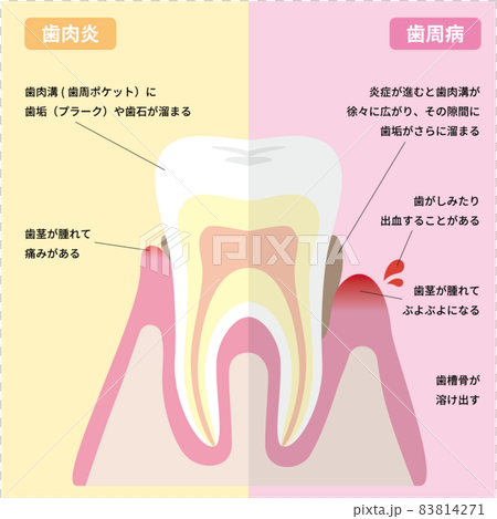 歯肉炎から歯周病への進行 説明付き のイラスト素材