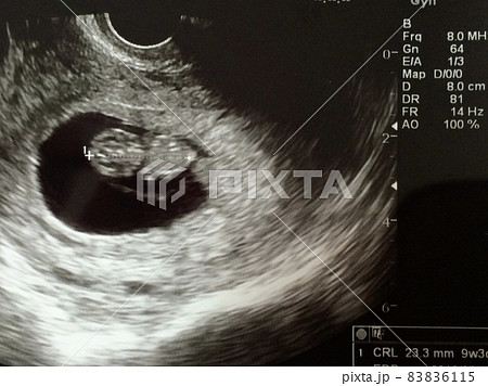 妊娠9週の赤ちゃんのエコー写真 83836115