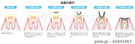 虫歯の進行　図解3 83845067