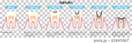 虫歯の進行　図解3 83845067