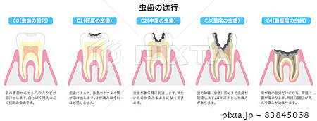 虫歯の進行 図解2 虫歯の進行 図解2 83845068