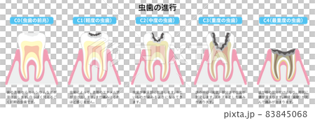 虫歯の進行 図解2 虫歯の進行 図解2 83845068