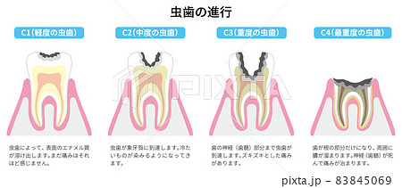 虫歯の進行 図解1 虫歯の進行 図解1 83845069