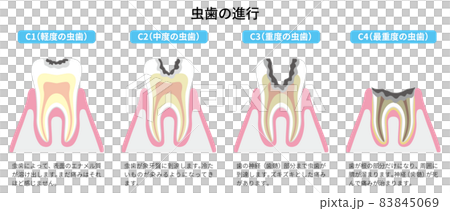 虫歯の進行 図解1 虫歯の進行 図解1 83845069