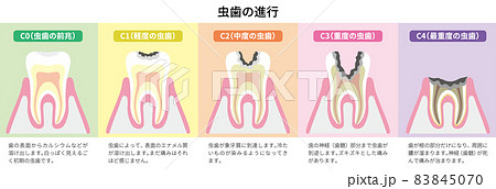 虫歯の進行　図解5 83845070