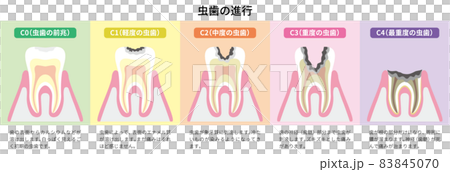 虫歯の進行　図解5 83845070
