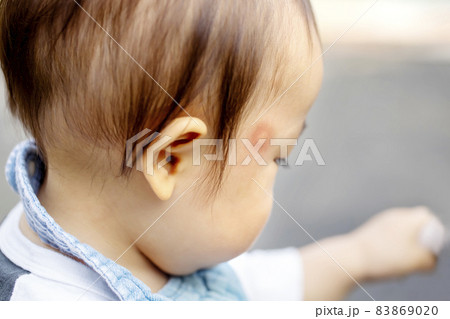 0才の男の子の横顔 蚊に刺されて赤くなっている 0才の男の子の横顔 蚊に刺されて赤くなっている 83869020