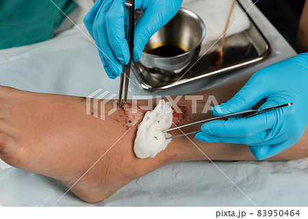 close up doctor cleaning wound on leg, Injuries from falling 83950464