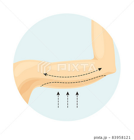 Liposuction of arms. Plastic or cosmetic surgery vector illustration 83958121