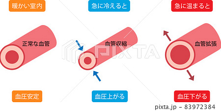 ヒートショック 血管収縮 血管拡張のイラスト素材