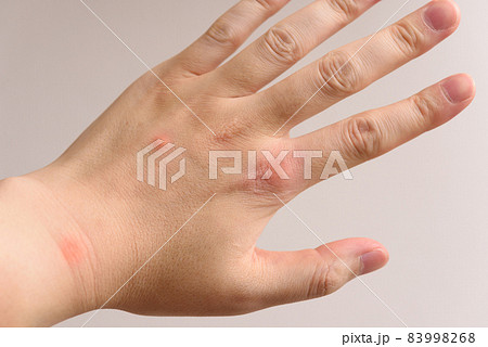 虫刺され 83998268