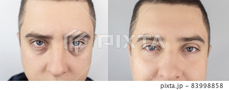 Before and after. Bags under eyes, hernias on the man face. Patient being examined by a plastic surgeon. Before and after blepharoplasty. Puffiness, skin folds and varicose veins in the eyelids Before and after. Bags under eyes, hernias on the man face. Patient being examined by a plastic surgeon. Before and after blepharoplasty. Puffiness, skin folds and varicose veins in the eyelids 83998858