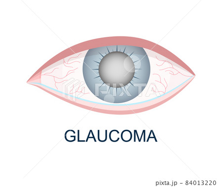 Eye with glaucoma closeup view. Hazy, redness, watery eyeball. Anatomically accurate human organ of vision. Aging visual problems. Vector illustration 84013220