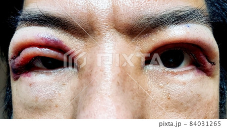 まぶたの手術後の様子、男性、目元 まぶたの手術後の様子、男性、目元 84031265
