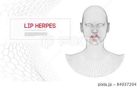 Herpes on lips . Woman herpes on face with treatment cold on the lips. Herpes on lips . Woman herpes on face with treatment cold on the lips. 84037204