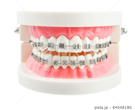 Teeth model wire dental braces isolated on white background. Teeth model wire dental braces isolated on white background. 84048180