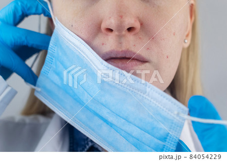 Doctor removes the protective mask and shows irritation on face skin. Antiviral measures. Means of protection against covid 19. Long wearing of a mask. Acne on face and chafing. Dry lips and red dots Doctor removes the protective mask and shows irritation on face skin. Antiviral measures. Means of protection against covid 19. Long wearing of a mask. Acne on face and chafing. Dry lips and red dots 84054229