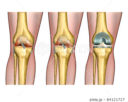 Knee replacement 84121727